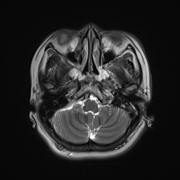 File:Cerebellopontine angle meningioma (Radiopaedia 53561-59591 Axial T2 5).jpg