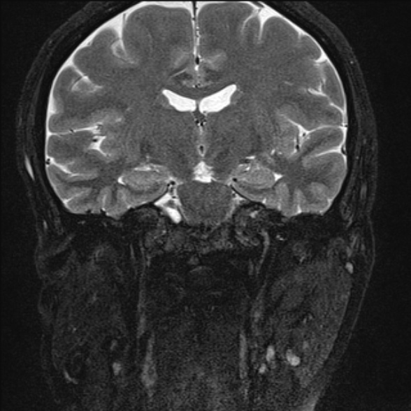 File:Cerebellopontine angle meningioma (Radiopaedia 53561-59591 Coronal T2 8).jpg