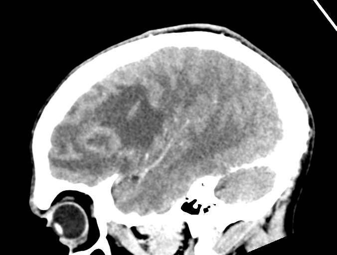 Cerebral abscess (Radiopaedia 60342-68008 Sagittal C+ delayed 39).png