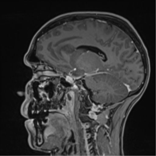 Cerebral abscess (Radiopaedia 60342-68009 J 25).png