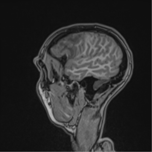 Cerebral abscess (Radiopaedia 60342-68009 Sagittal T1 47).png