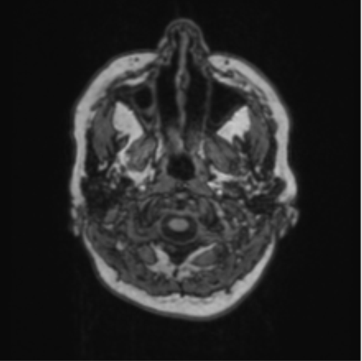 Cerebral abscess from pulmonary arteriovenous malformation (Radiopaedia 86275-102291 Axial T1 4).png