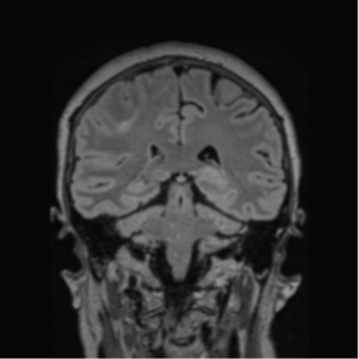 Cerebral abscess from pulmonary arteriovenous malformation (Radiopaedia 86275-102291 Coronal FLAIR 37).png