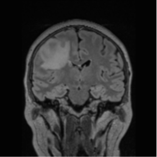 Cerebral abscess from pulmonary arteriovenous malformation (Radiopaedia 86275-102291 Coronal FLAIR 45).png