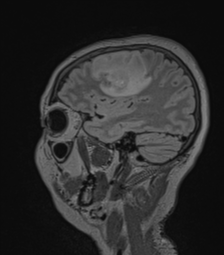 Cerebral abscess from pulmonary arteriovenous malformation (Radiopaedia 86275-102291 Sagittal FLAIR 55).png