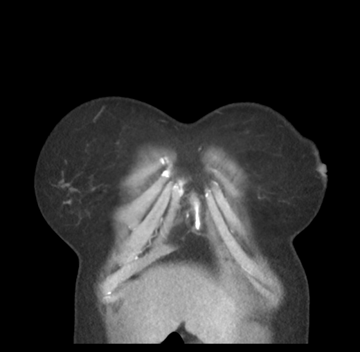 Cerebral abscess from pulmonary arteriovenous malformation (Radiopaedia 86275-102292 C 9).png