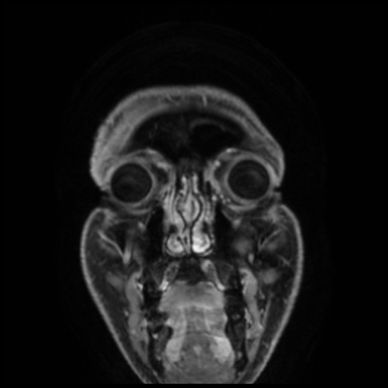 Cerebral abscess with ventriculitis (Radiopaedia 78965-91878 Coronal T1 C+ 8).jpg