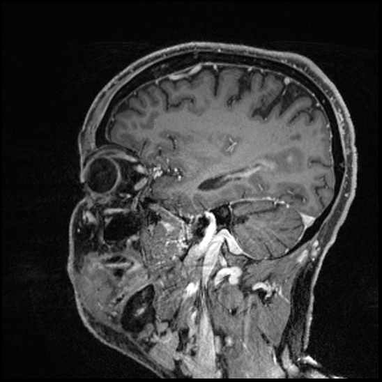 Cerebral abscess with ventriculitis (Radiopaedia 78965-91878 Sagittal T1 C+ 56).jpg