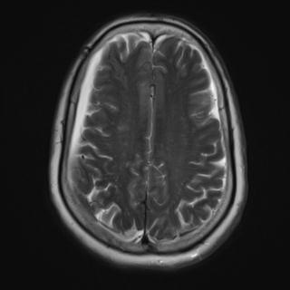 File:Cerebral amyloid angiopathy (Radiopaedia 29129-29518 Axial T2 15).jpg