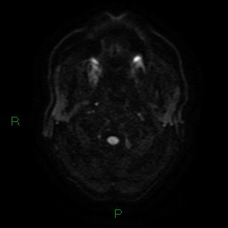 File:Cerebral amyloid angiopathy (Radiopaedia 77506-89664 Axial DWI 1).jpg
