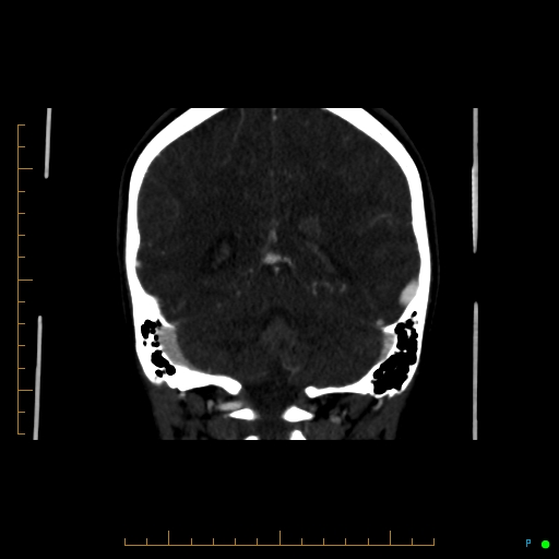 Cerebral arteriovenous malformation (AVM) (Radiopaedia 78162-90706 Coronal CTA 36).jpg