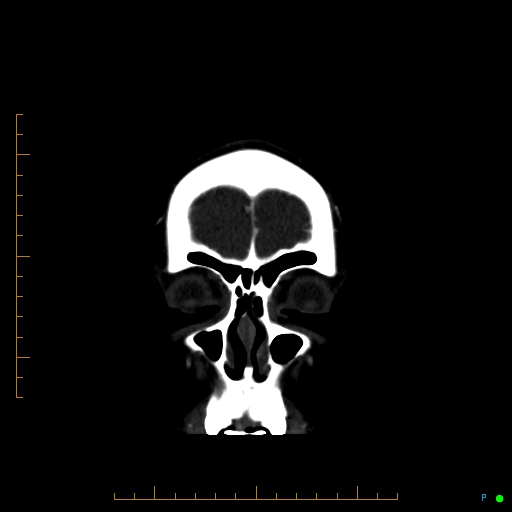 Cerebral arteriovenous malformation (AVM) (Radiopaedia 78162-90706 Coronal CTA 91).jpg