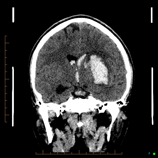 File:Cerebral arteriovenous malformation (AVM) (Radiopaedia 78162-90706 Coronal non-contrast 49).jpg