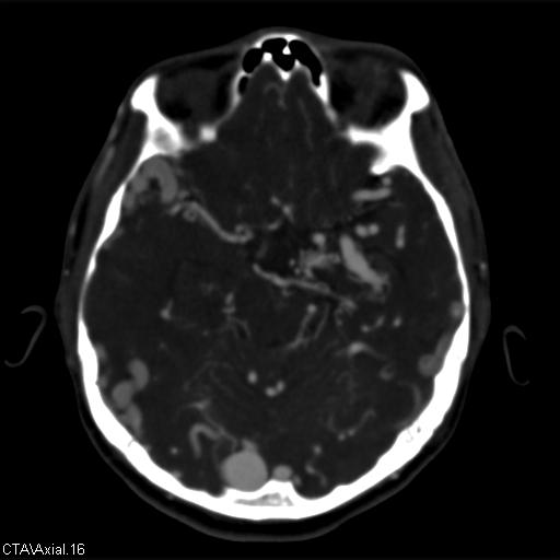 File:Cerebral arteriovenous malformation (Radiopaedia 28518-28759 B 16).jpg