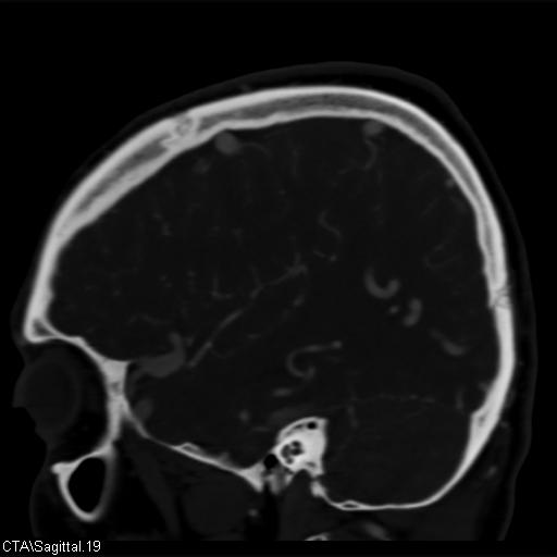 Cerebral arteriovenous malformation (Radiopaedia 28518-28759 D 16).jpg