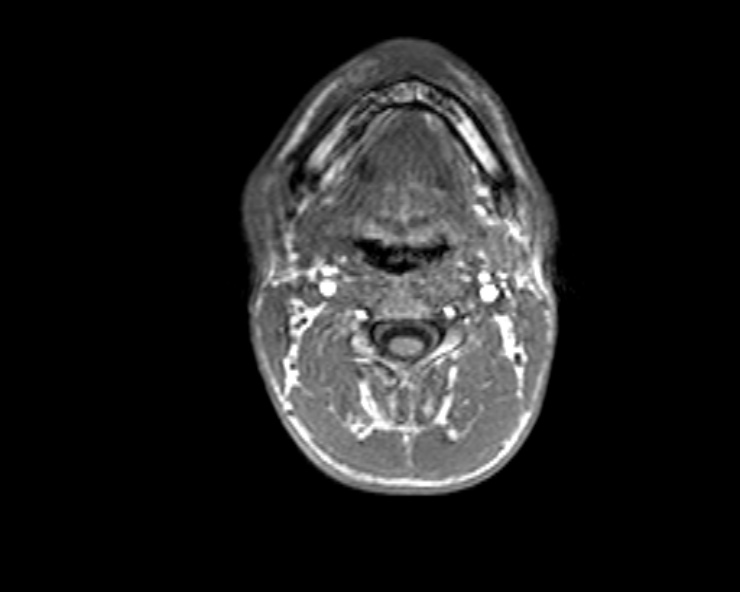 Cerebral arteriovenous malformation (Radiopaedia 30198-30813 Axial T1 64).jpg