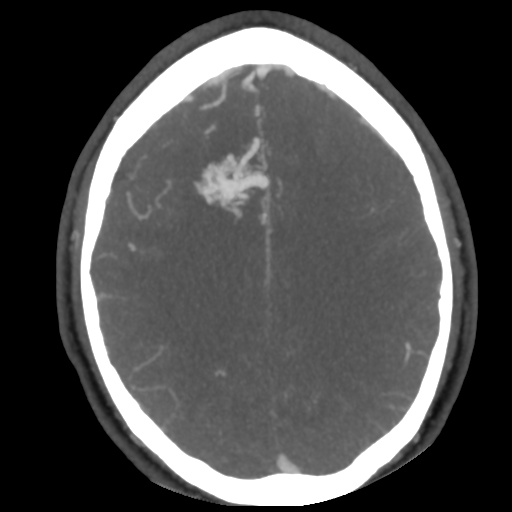 File:Cerebral arteriovenous malformation (Radiopaedia 39259-41505 AX CEREBRAL CTA 39).png