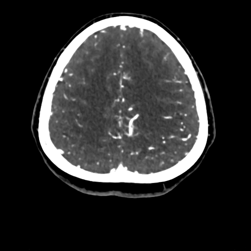 Cerebral arteriovenous malformation (Radiopaedia 73830-84645 Axial C+ delayed 20).jpg