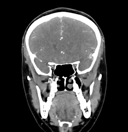 Cerebral arteriovenous malformation (Radiopaedia 73830-84645 C 33).jpg