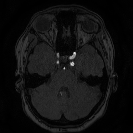 Cerebral arteriovenous malformation (Radiopaedia 74411-85654 Axial MRA 29).jpg