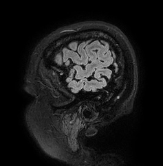 Cerebral arteriovenous malformation (Radiopaedia 74411-85654 Sagittal FLAIR 9).jpg