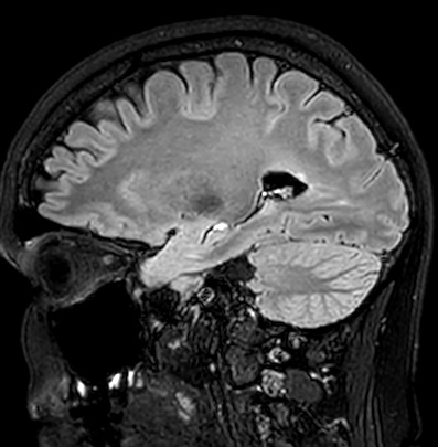 File:Cerebral arteriovenous malformation (Radiopaedia 74411-85746 Sagittal FLAIR 37).jpg