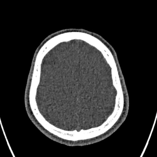 Cerebral arteriovenous malformation (Radiopaedia 78188-90746 Axial non-contrast 147).jpg