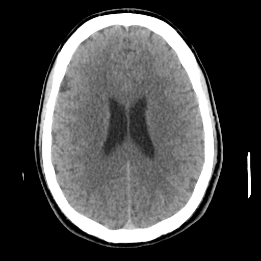 Cerebral arteriovenous malformation (Spetzler-Martin grade 2) (Radiopaedia 41262-44076 Axial non-contrast 35).png