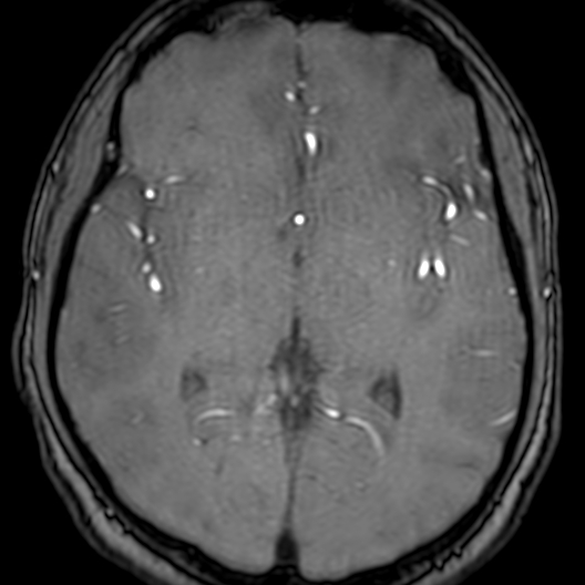 Cerebral arteriovenous malformation at posterior body of corpus callosum (Radiopaedia 74111-84925 Axial MRA 107).jpg