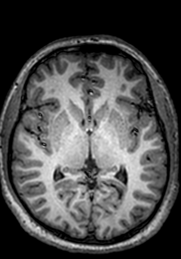 Cerebral arteriovenous malformation at posterior body of corpus callosum (Radiopaedia 74111-84925 Axial T1 148).jpg