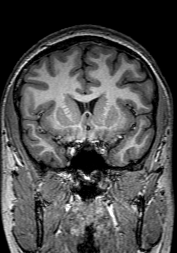 Cerebral arteriovenous malformation at posterior body of corpus callosum (Radiopaedia 74111-84925 Coronal T1 113).jpg
