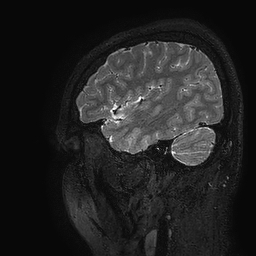 Cerebral arteriovenous malformation at posterior body of corpus callosum (Radiopaedia 74111-84925 Sagittal T2 19).jpg