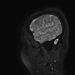 Cerebral arteriovenous malformation at posterior body of corpus callosum (Radiopaedia 74111-84925 Sagittal T2 7).jpg