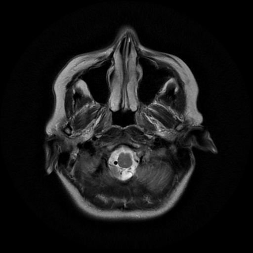 File:Cerebral autosomal dominant arteriopathy with subcortical infarcts and leukoencephalopathy (CADASIL) (Radiopaedia 41018-43768 Ax T2 PROP 2).png