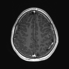 Cerebral cavernous venous malformation (Radiopaedia 70008-80021 Axial T1 C+ 74).jpg