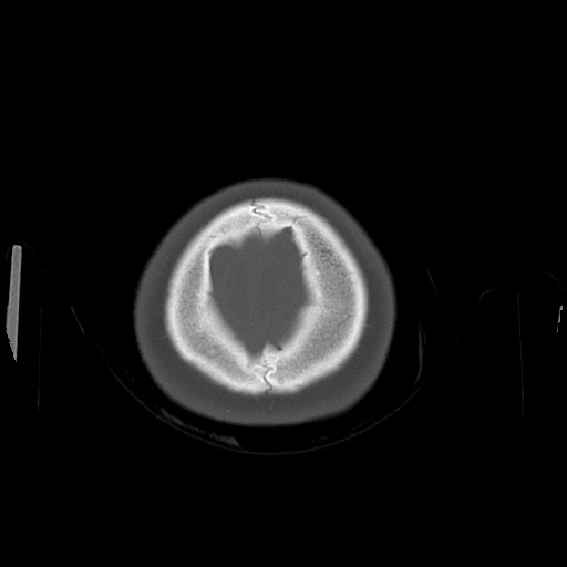 Cerebral cavernous venous malformation (Radiopaedia 70008-80022 Axial bone window 54).jpg