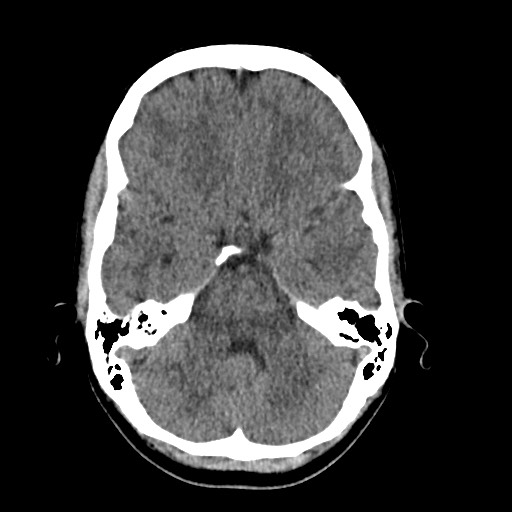File:Cerebral cavernous venous malformation (Radiopaedia 70008-80022 Axial non-contrast 14).jpg