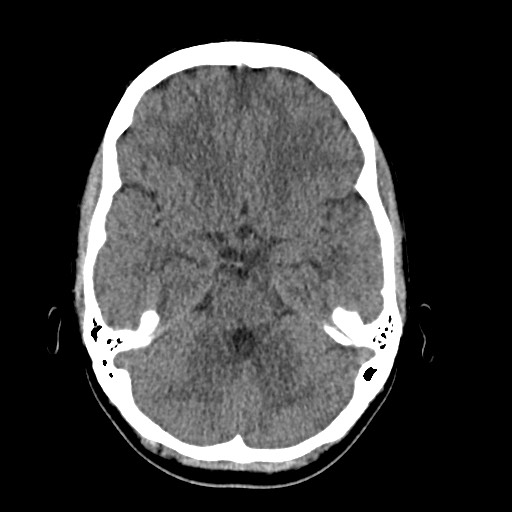 Cerebral cavernous venous malformation (Radiopaedia 70008-80022 Axial non-contrast 16).jpg