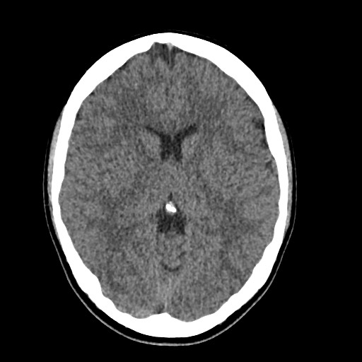 Cerebral cavernous venous malformation (Radiopaedia 70008-80022 Axial non-contrast 25).jpg