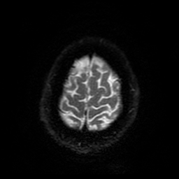 Cerebral cavernous venous malformation (Zabramski type II) (Radiopaedia 85511-101198 Axial DWI 94).jpg