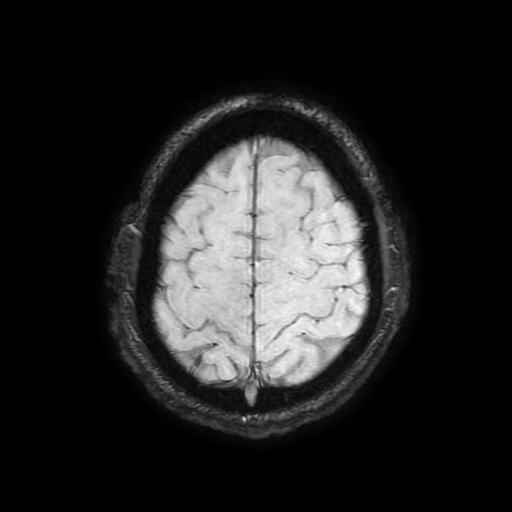 Cerebral cavernous venous malformation (Zabramski type II) (Radiopaedia 85511-101198 Axial SWI 99).jpg