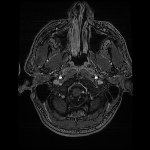 Cerebral cavernous venous malformation (Zabramski type II) (Radiopaedia 85511-101198 Axial T1 C+ fat sat 76).jpg