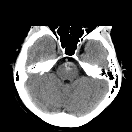 File:Cerebral cavernous venous malformations (Radiopaedia 48117-52945 Axial non-contrast 11).png