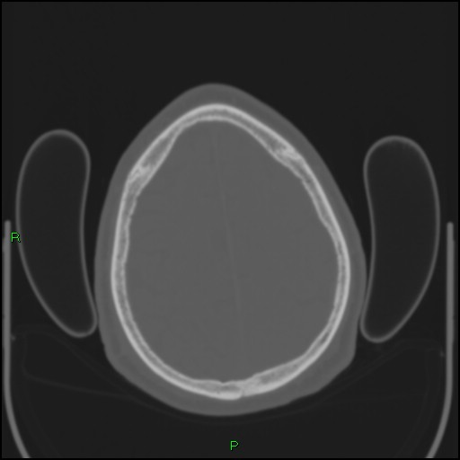 Cerebral contusions (Radiopaedia 33868-35039 Axial bone window 178).jpg