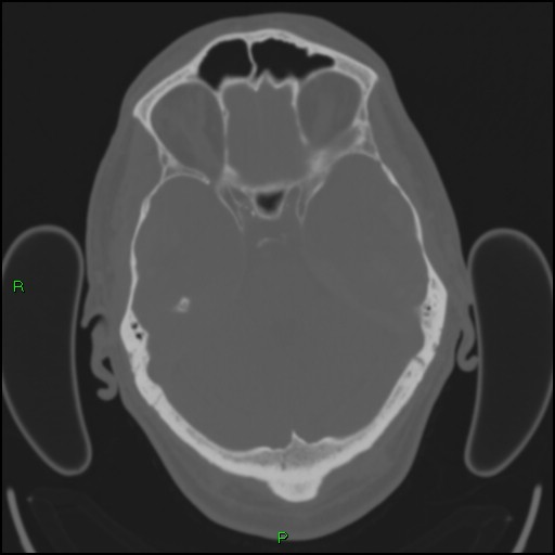 File:Cerebral contusions (Radiopaedia 33868-35039 Axial bone window 62).jpg