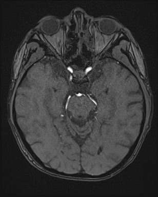 Cerebral embolic infarcts (embolic shower) (Radiopaedia 72391-82921 Axial MRA 57).jpg