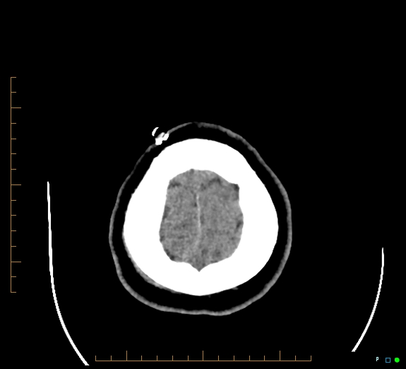 Cerebral fat embolism (Radiopaedia 85521-101220 Axial non-contrast 55).jpg