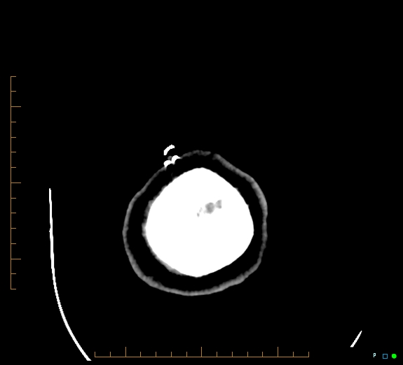 Cerebral fat embolism (Radiopaedia 85521-101220 Axial non-contrast 58).jpg