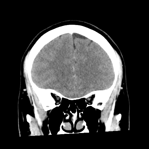 Cerebral hemorrhage secondary to arteriovenous malformation (Radiopaedia 33497-34561 C 20).png