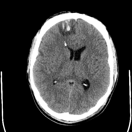 File:Cerebral hemorrhagic contusions- temporal evolution (Radiopaedia 40224-42754 Axial non-contrast 15).png